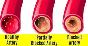 cross section of arteries showing a healty artery, partially blocked artery, and a blocked artery showing the symptoms of blocked arteries